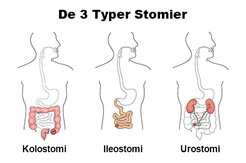 3-types-of-ostomies-illustration